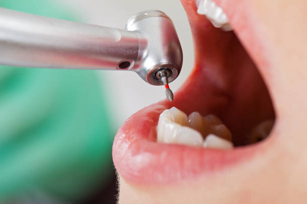 Best Emergency Tooth Extraction in Mesquite, NV